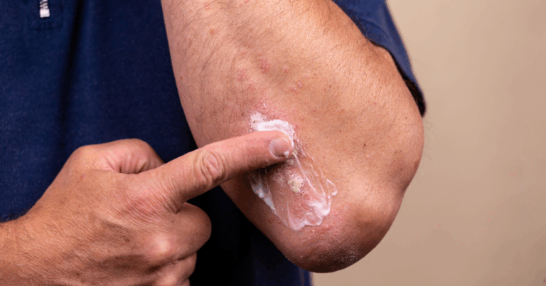 Allergy and Itch Relief